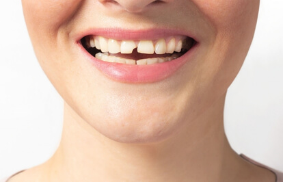 Broken or Chipped Tooth Repair