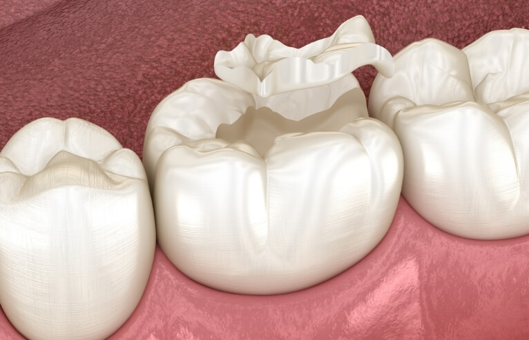 Children’s Tooth-Coloured Fillings