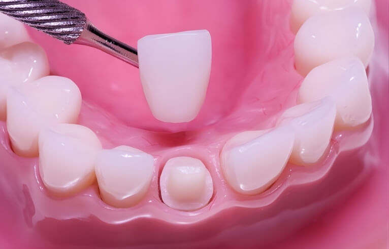 Cosmetic Dental Crowns