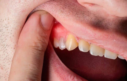 Dental Abscess & Infection Management