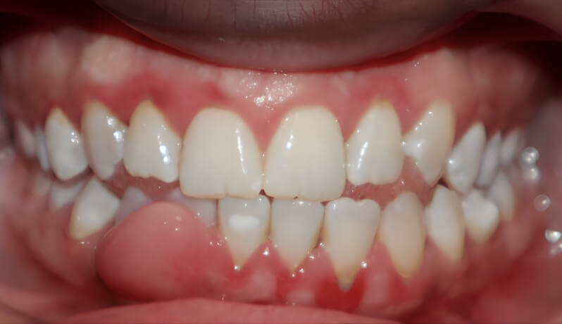Gingival Abscess