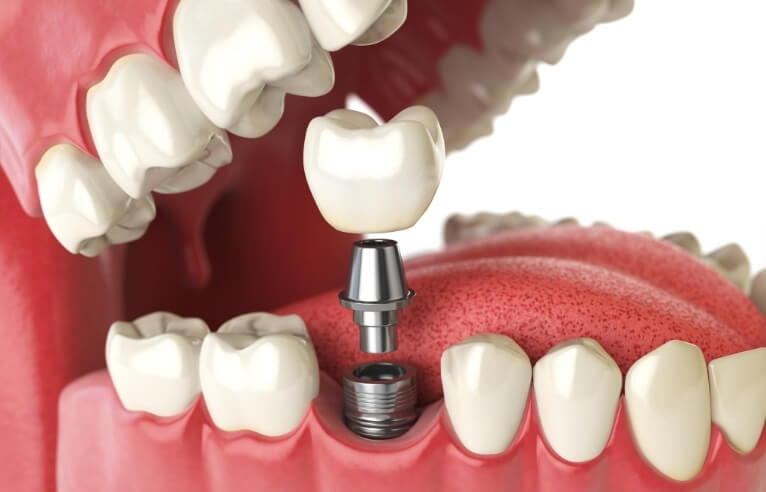 Implant-Supported Dentures