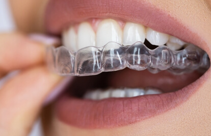 Night Guards (Bruxism)