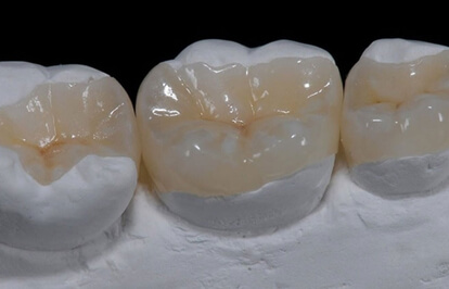 Onlays & Inlays