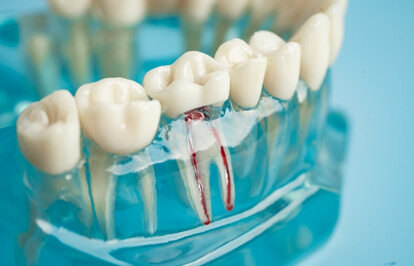 Root Canal Treatment