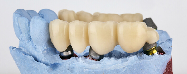 What Is a Dental Bridge?