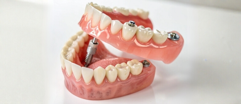 What to Expect with New Dentures