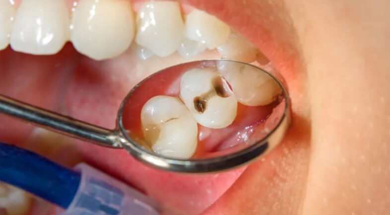 What Are Tooth-Coloured Composite Fillings?
