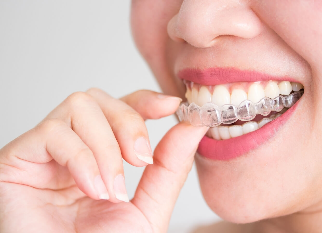 Why Choose Invisalign?